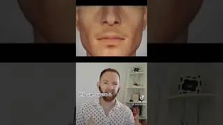 Bone loss due to missing teeth.