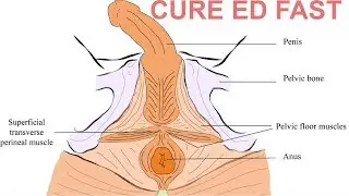 Effective Exercise To Cure Erectile Dysfunction Naturally At Home | Exercise To Cure ED