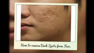 Hindi/Urdu | How to Remove Pimple Spot | Remove acne pimples |
