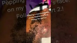 Black head removal on face - Blackheads on back treatment