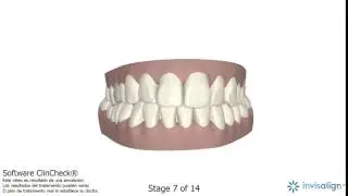 ClinCheck Invisalign® 1