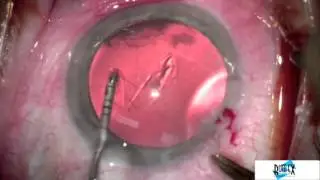 0015    Effortless rrhexis measurement with Lesieur Capsulorrhexis Forceps  23Ga Rumex