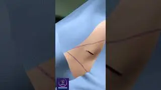 Chest Tube Insertion 