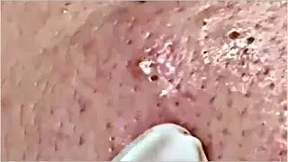Tokyo Acne Treatment Blackhead Extractions Popping | HaiAu #54