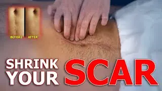 Painful Or Unsightly Scar? Shrink Your Scar With This EASY SCAR TISSUE MASSAGE | Physical Therapist