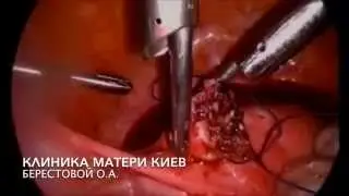 ЛАПАРОСКОПИЯ ФИБРОМАТОЗНЫЙ УЗЕЛ УДАЛЕН ПРАКТИЧЕСКИ БЕСКРОВНО! ПРОСТО И БЫСТРО
