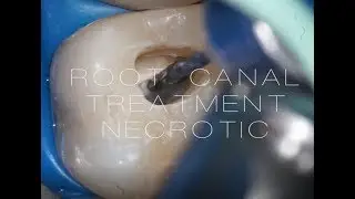 ROOT CANAL TREATMENT 1.6 necrotic case