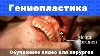 Операция: Гениопластика (длинный Chin-Wing со срединной остеотомией)
