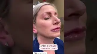 Lip Filler using Juvederm Ultra XC