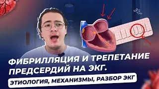 Фибрилляция и трепетание предсердий на ЭКГ  Этиология, механизмы, разбор ЭКГ