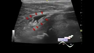 Pediatric ultrasound of the knee joints - Baker's cyst and intramuscular hematoma