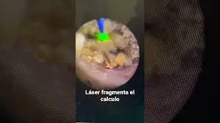 LASER para piedras del riñón | #urotips