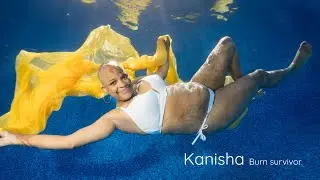 Kanisha - Burn survivor