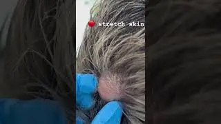 Scalp cyst complication #skincare dr Khaled Sadek