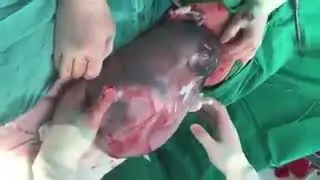 Caesarean Section or Delivery কিভাবে করে। ২ মিনিটে দেখে নিন ?
