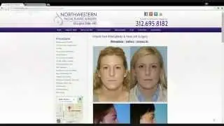 best rhinoplasty surgeon in  orland park il