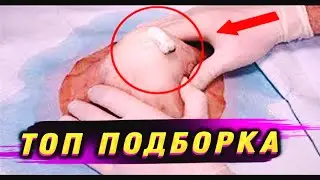 Выдавливание ПРЫЩЕЙ УГРИ выдавливание черных точек ОГромный чирий