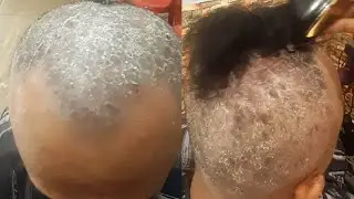 Waspada terhadap penyakit seperti ini, begini penjelasan bapak ini (PSORIASIS) 