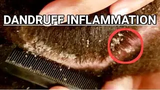 waspadalah ketombe tebal di kulit kepala sebelum berakibat fatal(Maliknant dandruff in the hair).