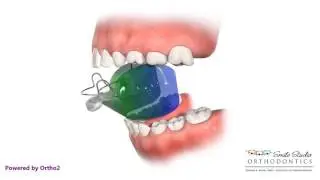 Bionator - Orthodontic Treatment - Deep Bite - Overjet