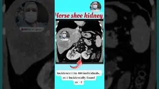 Coronal section CECT abdomen & pelvis of horseshoe kidney. #trending #youtubeshorts #video #viral