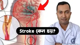 stroke কেন হয়? stroke থেকে বাঁচার উপায়!