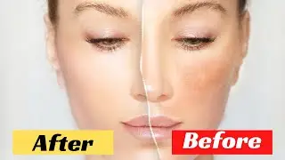 In 3 DAYS Remove Dark Black Patches, Dark Spots |