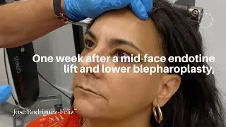 One week after a mid-face endotine lift and lower blepharoplasty.