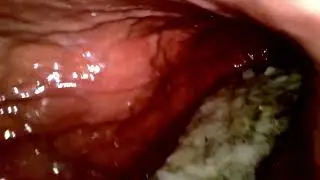 Empty Stomach | EndoCam
