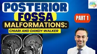 Posterior Fossa Malformations Part 1: Chiari and Dandy-Walker Malformations