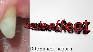 ferrule effect [fixed prothodontic]how to gain it by surgery or ortho