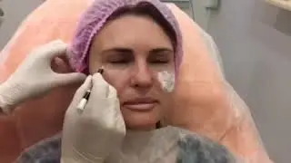 Коррекция скул филером в клинике Аура