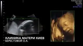 ЭТО ВИДНО НА УЗИ! Положительные эмоции у мамы= смех у малыша.