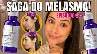 Testando o MELA B3 da La Roche: Resultados em 14 Dias - Saga do Melasma Ep. 4