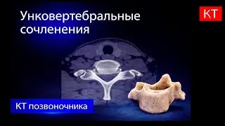 Унковертебральные сочленения на КТ