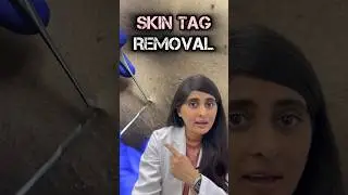 Skin tag removal | Skin tags  on neck | How to remove skin tag