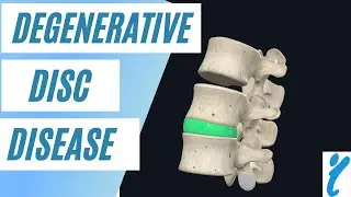 Degenerative Disc Disease Explained