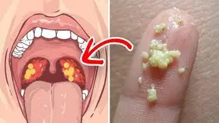 علامات تحذيرية لحصى اللوزتين لايجب أبدا تجاهلها