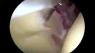 Hip Labrum Tear and Acetabular Wave Sign