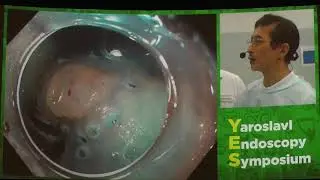 18Live Tohru Itoh Ранний рак желудка удаление ESD