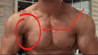 Bodybuilding w/ PEC TEAR Part 1