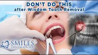 Wisdom Tooth Removal: Things You MUST Avoid! (2025)