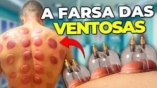 A Verdade DOLOROSA sobre a VENTOSATERAPIA