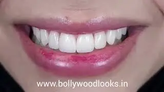 Smile Designing