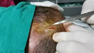 Sebacea cyst -Yağ kisti  saçlı deride