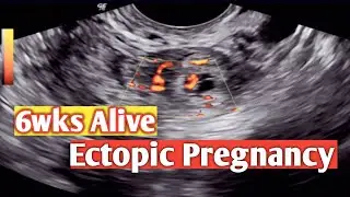 Alive Ectopic Pregnancy 6 wks - TVS Ultrasound | Pregnancy in Tube