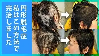 多発性円形脱毛症. 私はこのように治しました。
