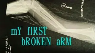 MY BROKEN ARM (Radius and Ulna)