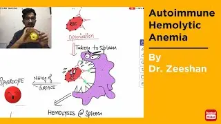 Autoimmune Hemolytic Anemia in Hindi / Hinglish ft. Robbin’s pathology  #neet_pg_2022  #inicet
