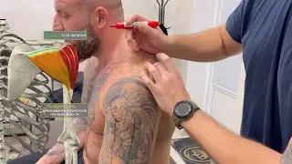 Боль в плече. Замороженное плечо. Отказался от глупой операции. 